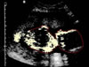 Baby Cornillot Outline 022504