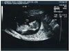 Feb. 12, 2007 Sonogram