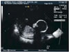 April 12, 2007 Sonogram