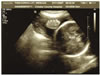 July 11, 2007 Sonogram
