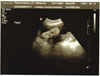 July 11, 2007 Sonogram